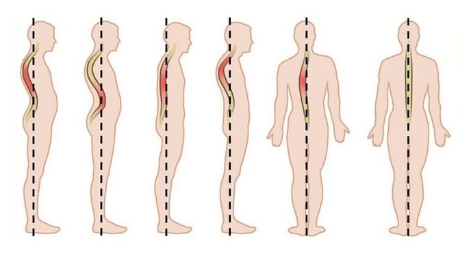 distúrbios de postura como causa de osteocondrose torácica
