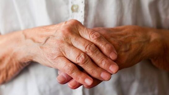 A artrite reumatóide causa dor e inchaço nas articulações dos dedos. 