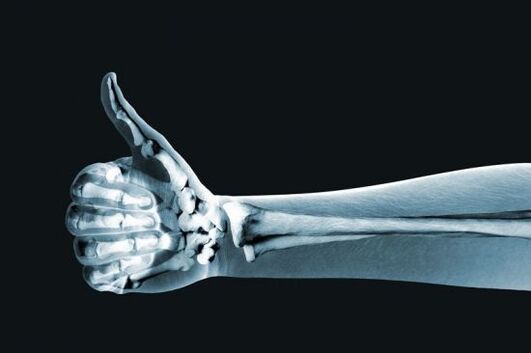 O raio X pode ajudar a diagnosticar dores nas articulações dos dedos