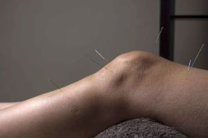 A acupuntura promove a reparação do tecido articular