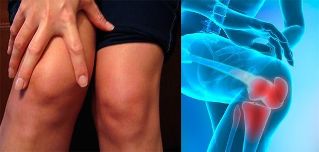 Desconforto e inchaço na área do joelho são os primeiros sintomas da artrose