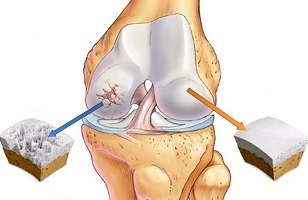 causas de artrose da articulação do joelho