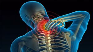 causas de osteocondrose do pescoço